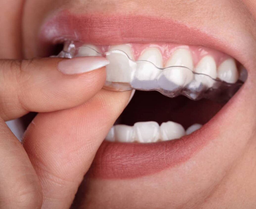 Invisalign